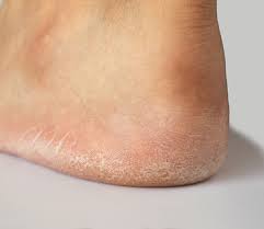 how to heal a cracked toe skin