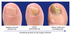 progress of toenail fungus