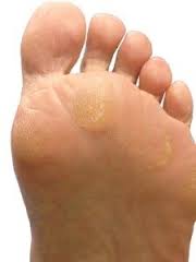 callus-on-toe