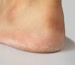 cracked-feet