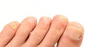 yellow brittle toenails
