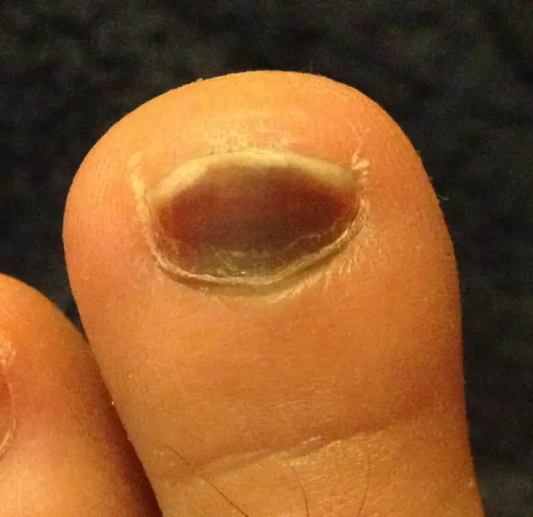 why-is-my-pinky-toe-so-small-and-not-growing-toe-fungus-journey